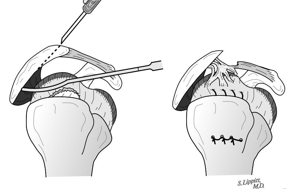 4 肩袖损伤修复手术后的肩<!--HAODF:8:guanjiesunshang-->关节粘连<!--HAODF:/8:guanjiesunshang-->.JPG