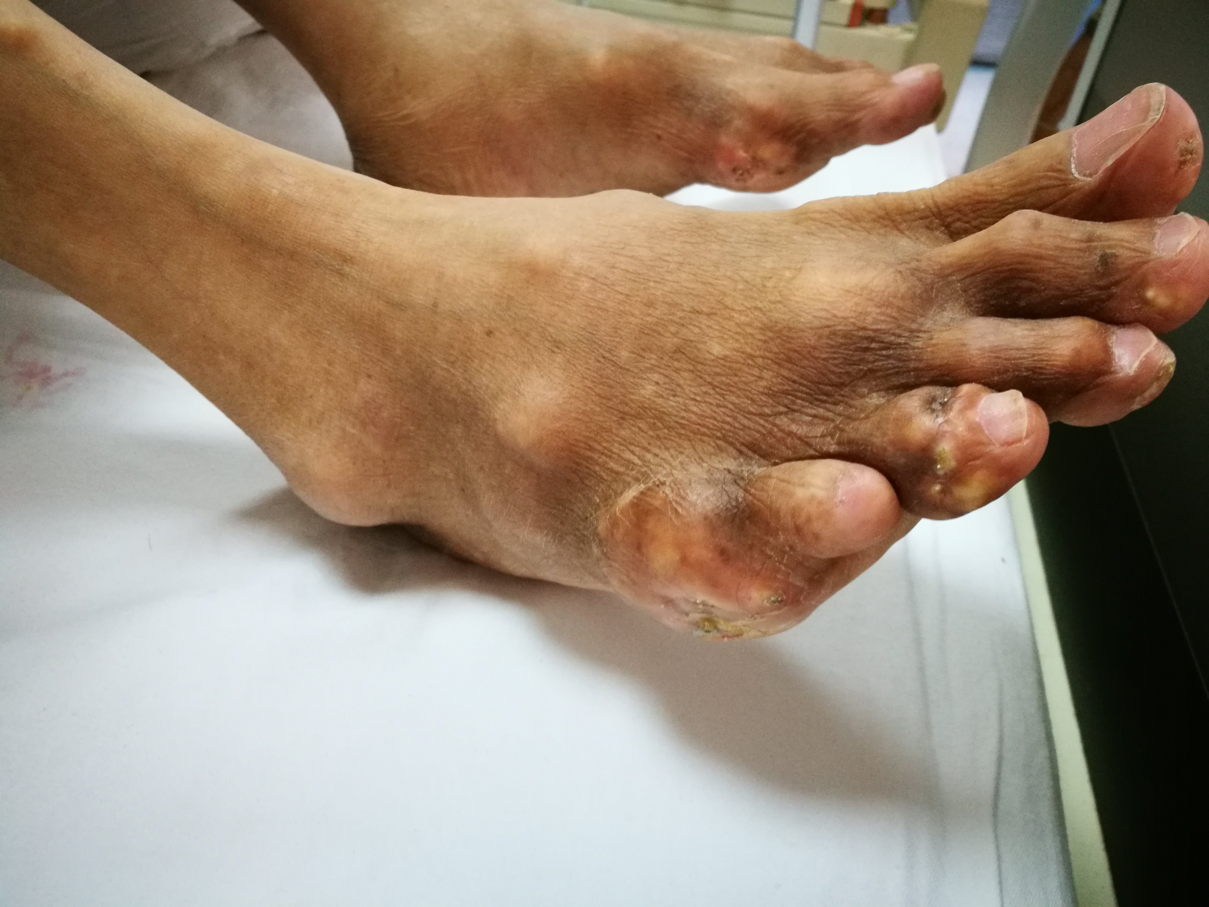 谨记痛风需正规治疗