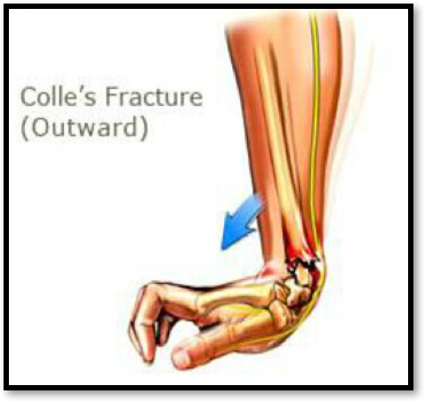 是Colles骨折而不是 colles骨折