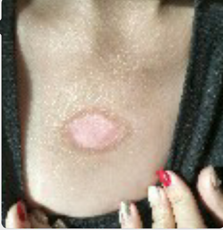 治疗瘢痕疙瘩同位素敷贴治疗最有效(山东青岛