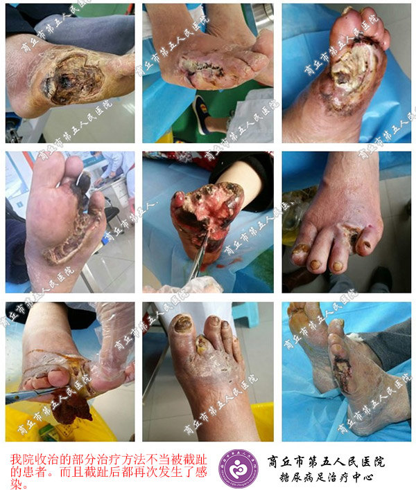 高压氧能不能做为糖尿病足治疗的主要方法_好