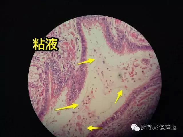 病理影像综合分析粘液性腺癌的枯枝征