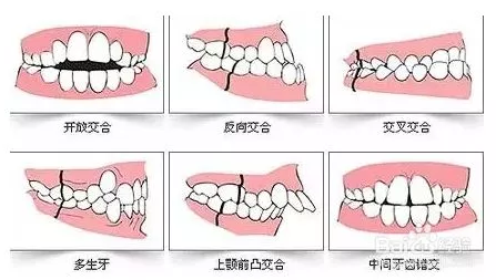 上牙前突、下巴前翘、嘴巴歪偏等牙颌畸形,怎