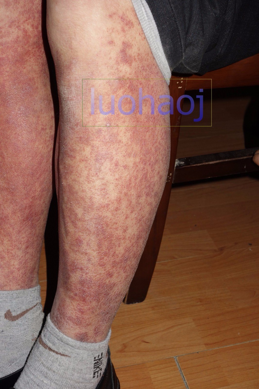 严重的双下肢小腿对称性色素紫癜样皮炎中西结