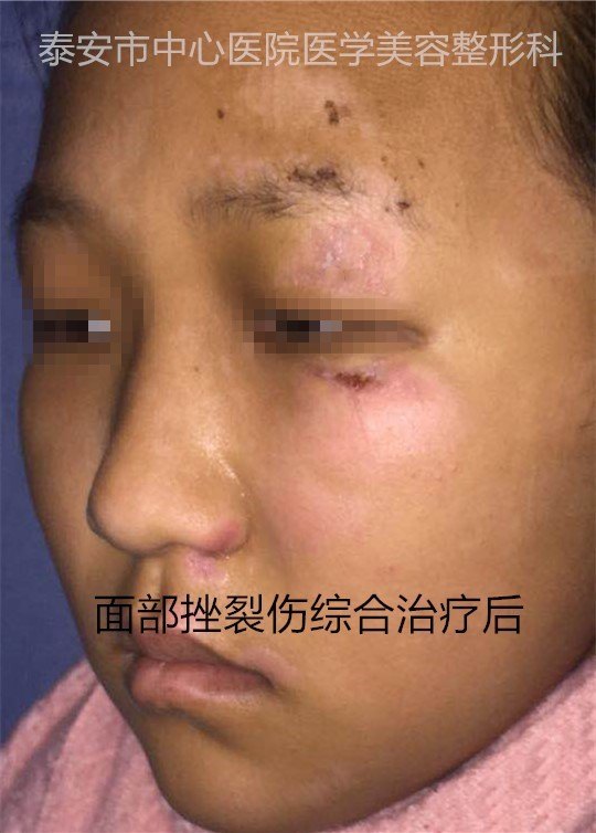 面部外伤后综合处理对比