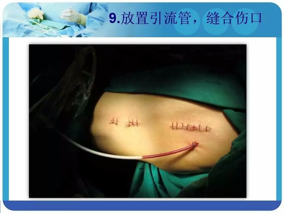 pfna治疗股骨粗隆间骨折,让你看明白