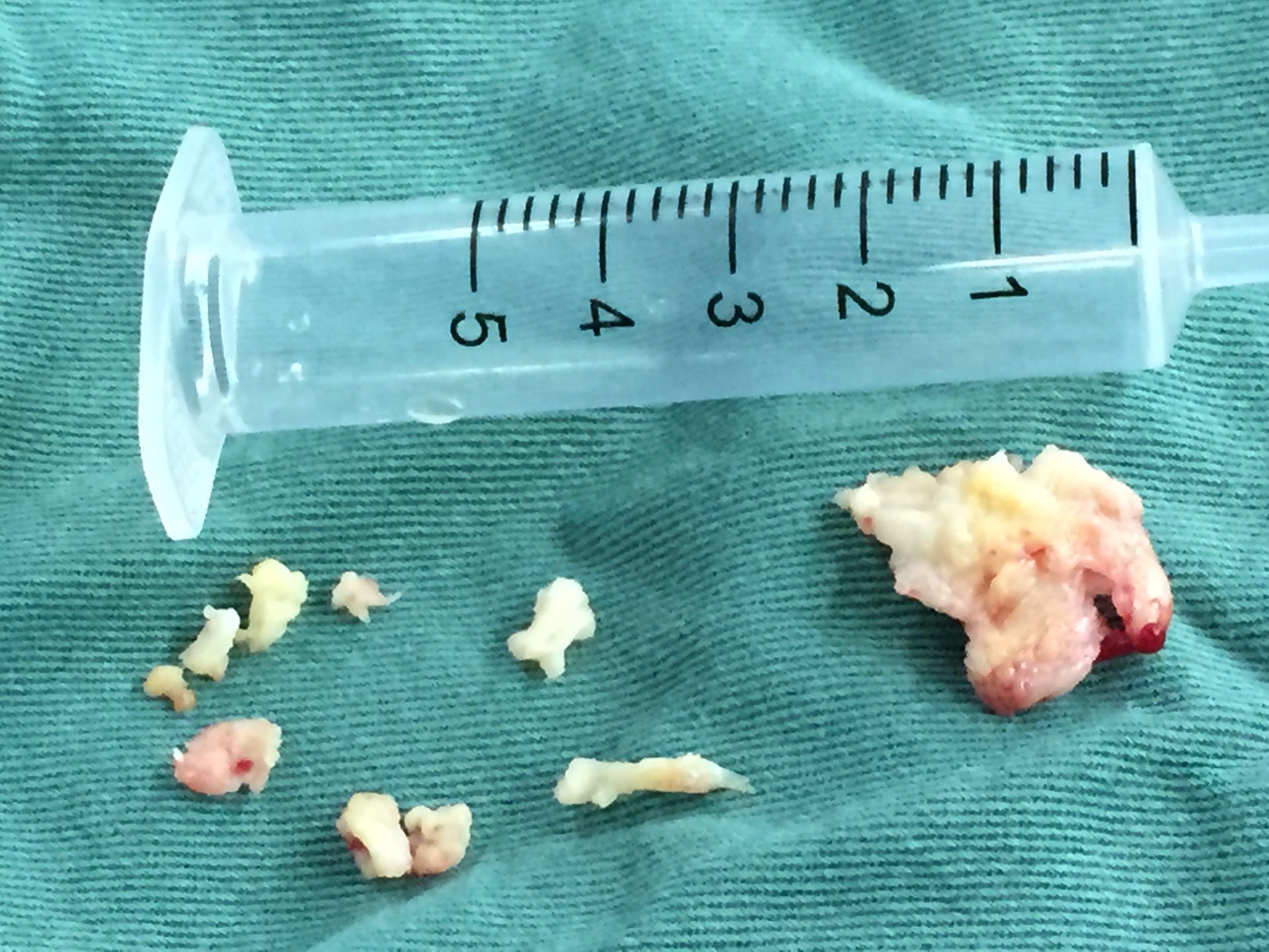 腰椎间盘突出治疗最后一块拼图--椎间孔镜下髓