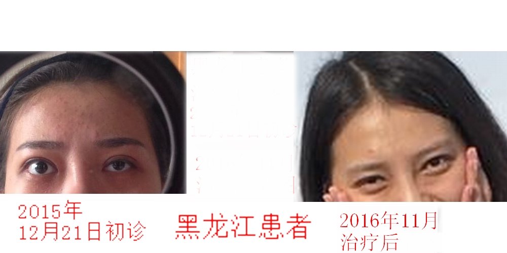 重症甲亢突眼怎么治疗?突眼典型病例治疗前后照片对照