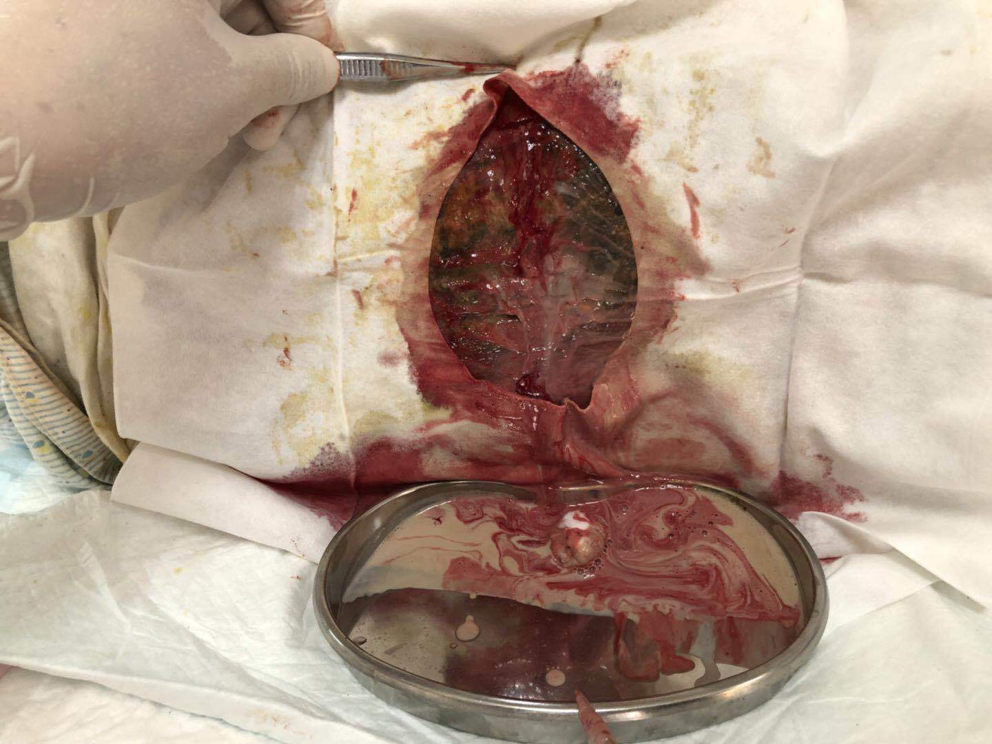 糖尿病患者合并高血压、冠心病,带状疱疹、背