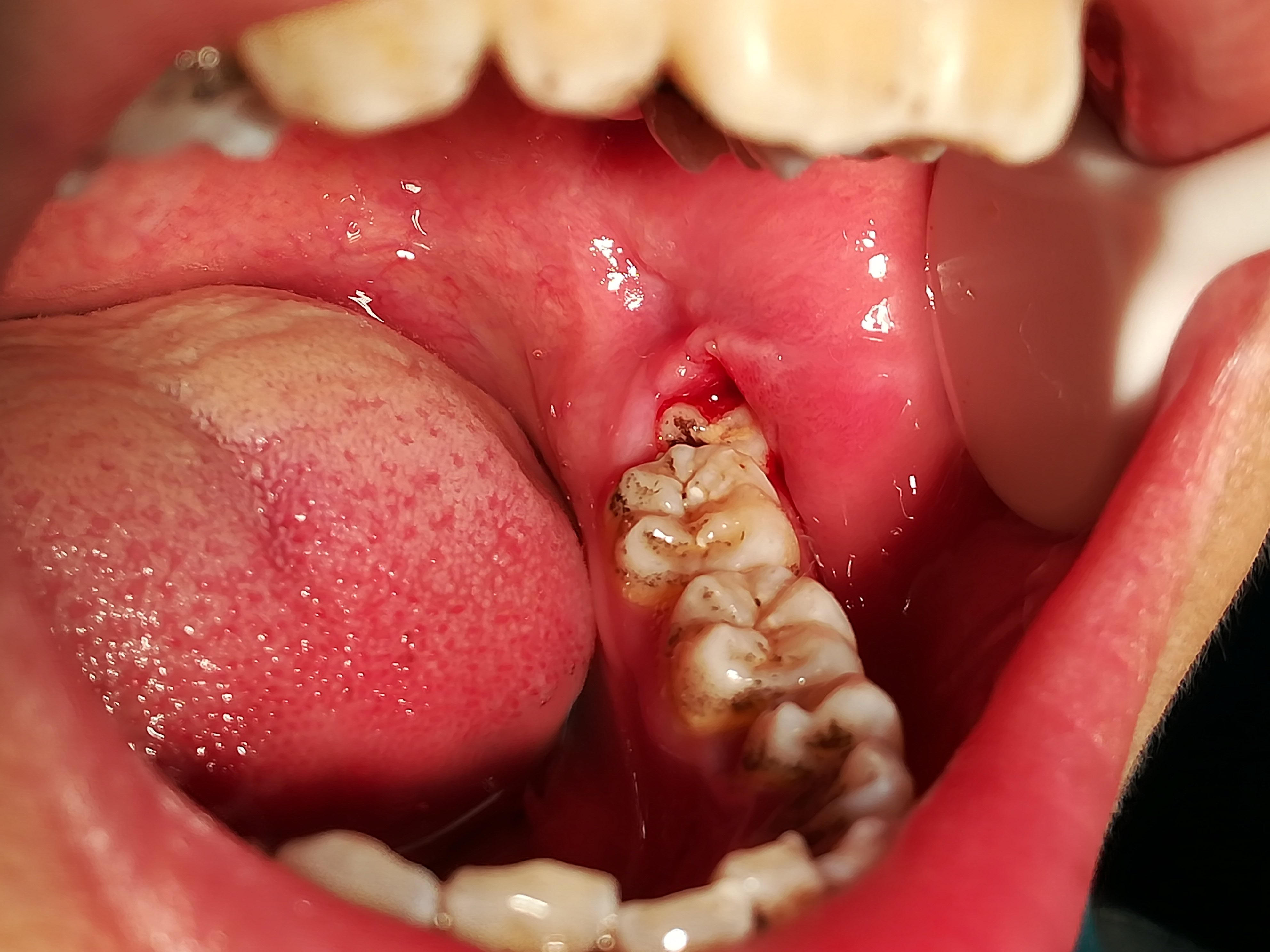 5.智齿发生蛀牙 智齿因为位于最后方,刷牙经常被忽略,容易长蛀牙.