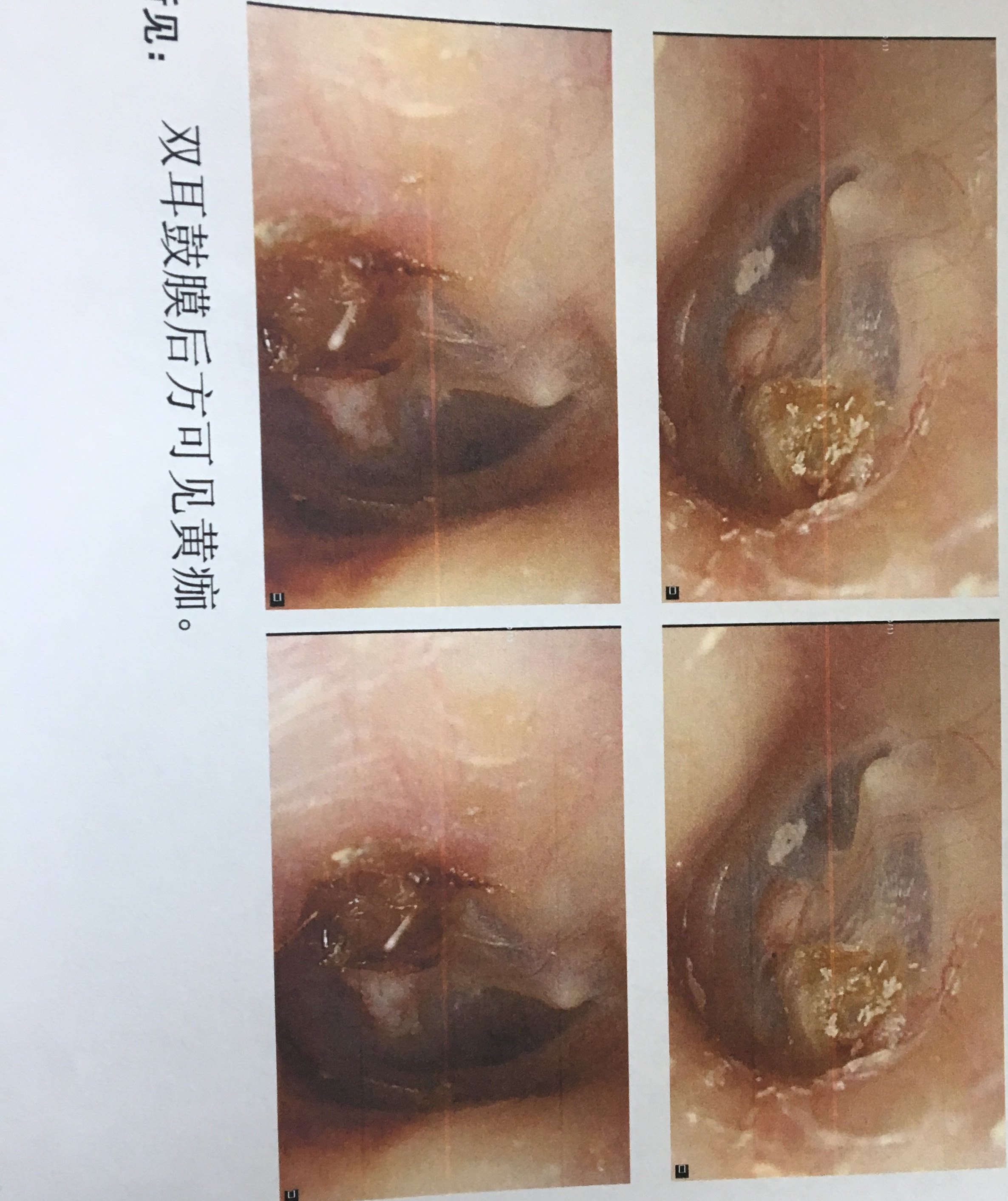 耳内镜微创手术简单来说,就是有一根线,一端连着特殊的镜子,另一端