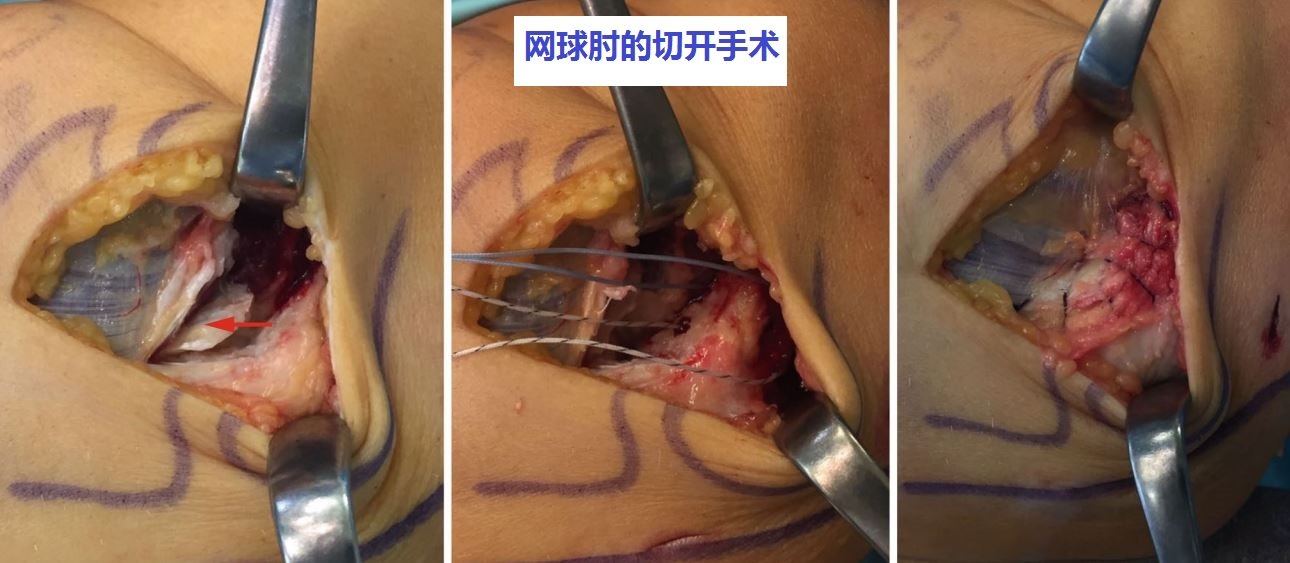 怎么治疗网球肘?保守还是手术?