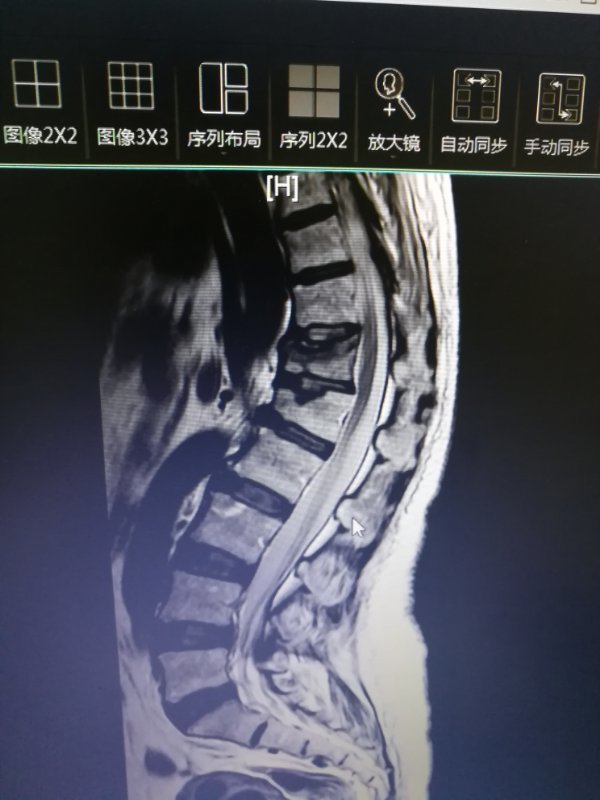 胸12反复压缩骨折,手术效果立竿见影