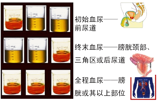 无痛血尿要警惕膀胱肿瘤!