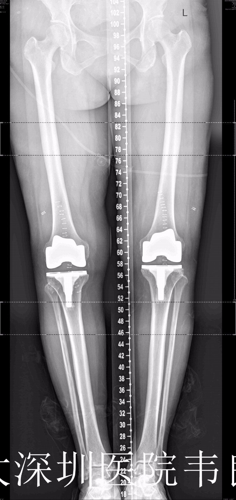 膝关节表面置换术x片示例 好大夫在线