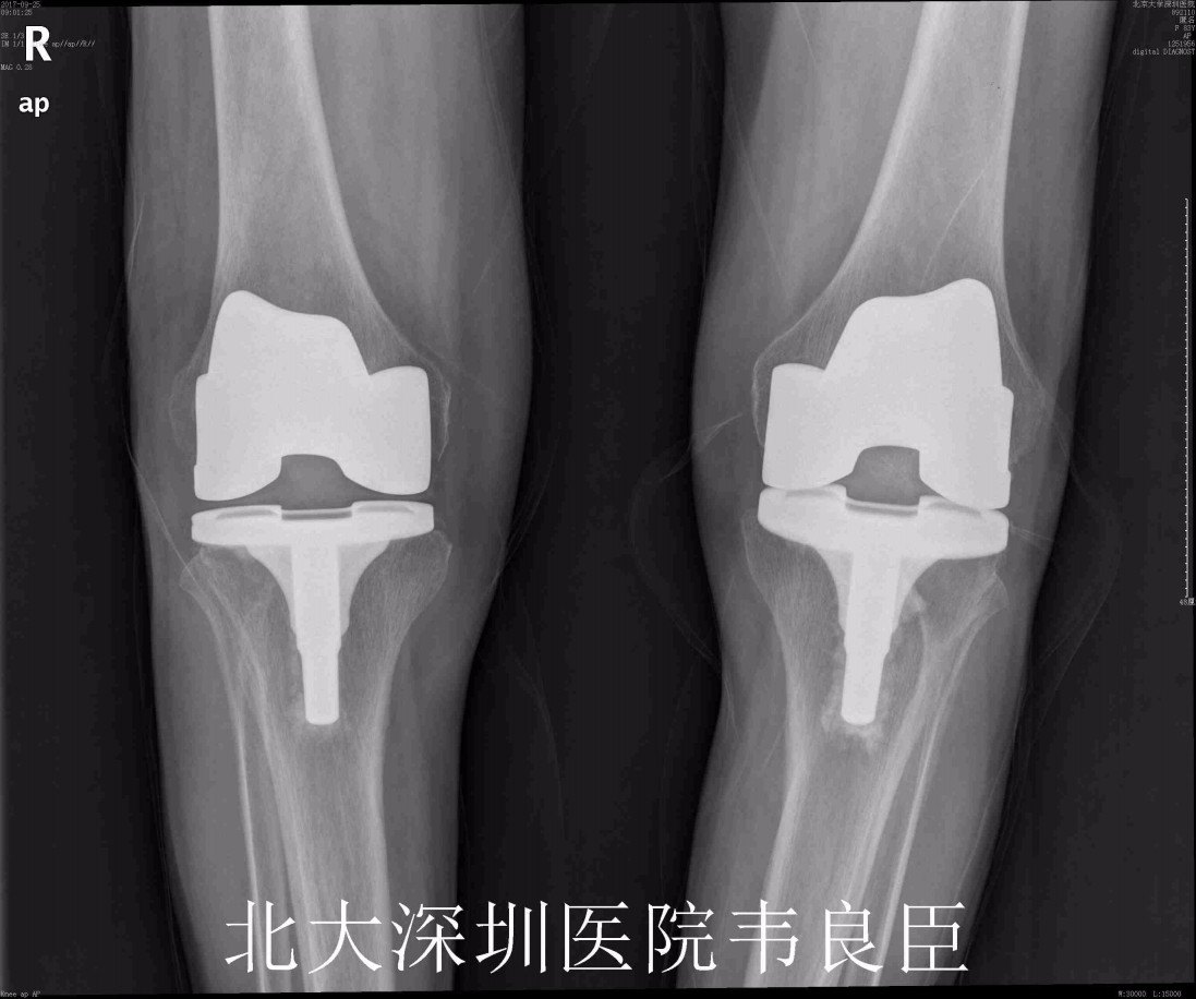 膝关节表面置换术x片示例
