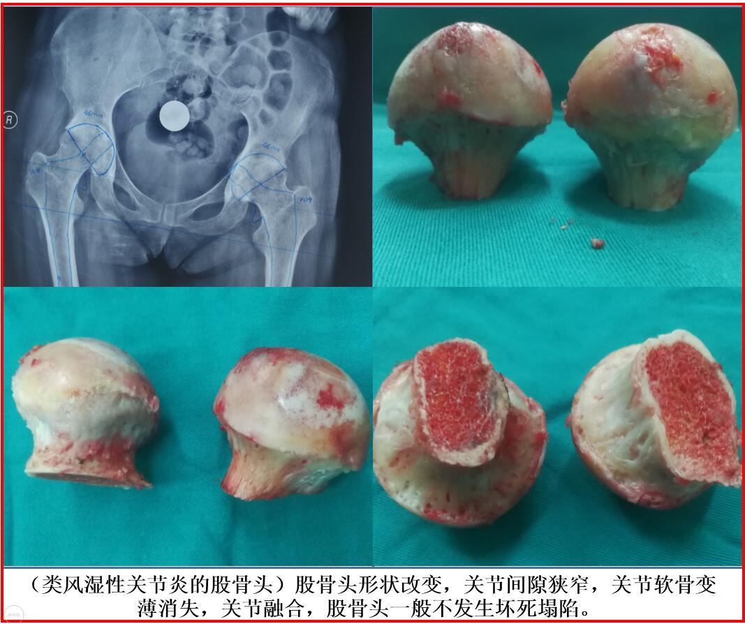 股骨头坏死到底长什么样子?