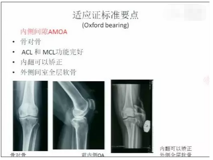 【骨关节炎】膝关节单间室置换的技术要点