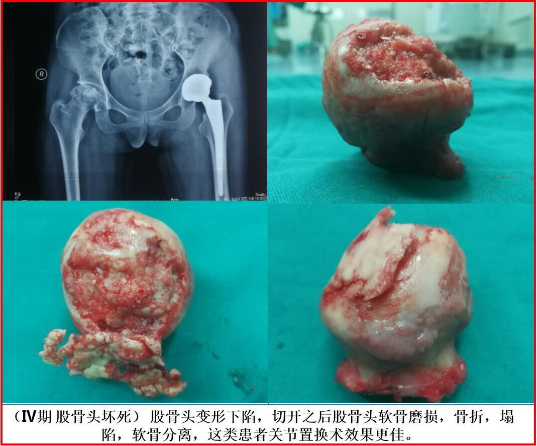 股骨头坏死到底长什么样子?