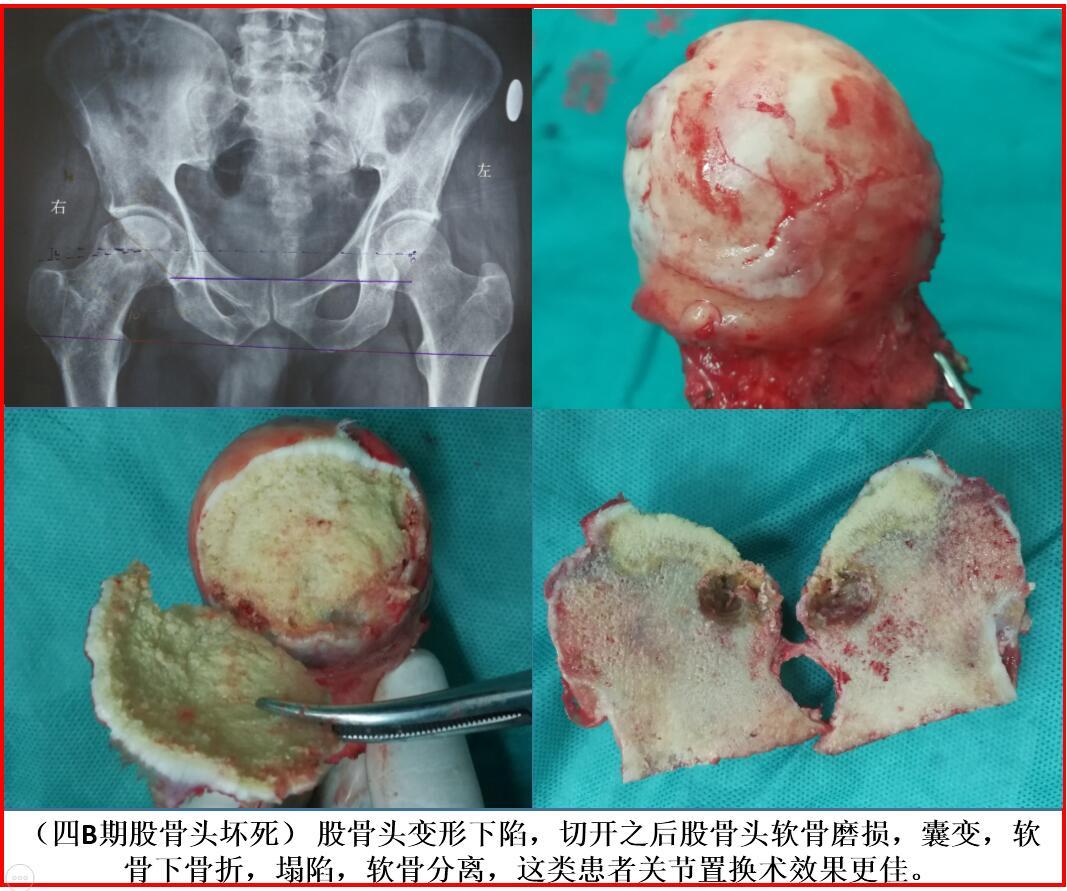 股骨头坏死的分期(steinberg 分期)