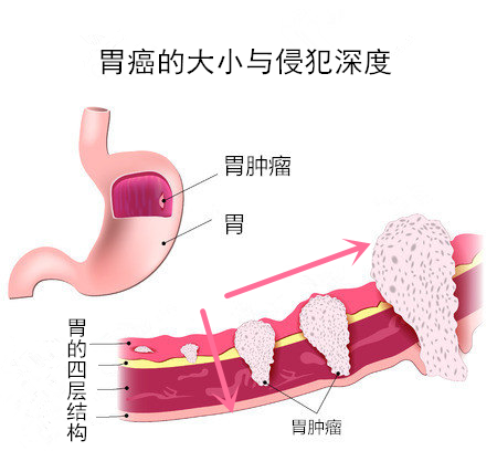 胃癌TNM分期和分化是什么意思?