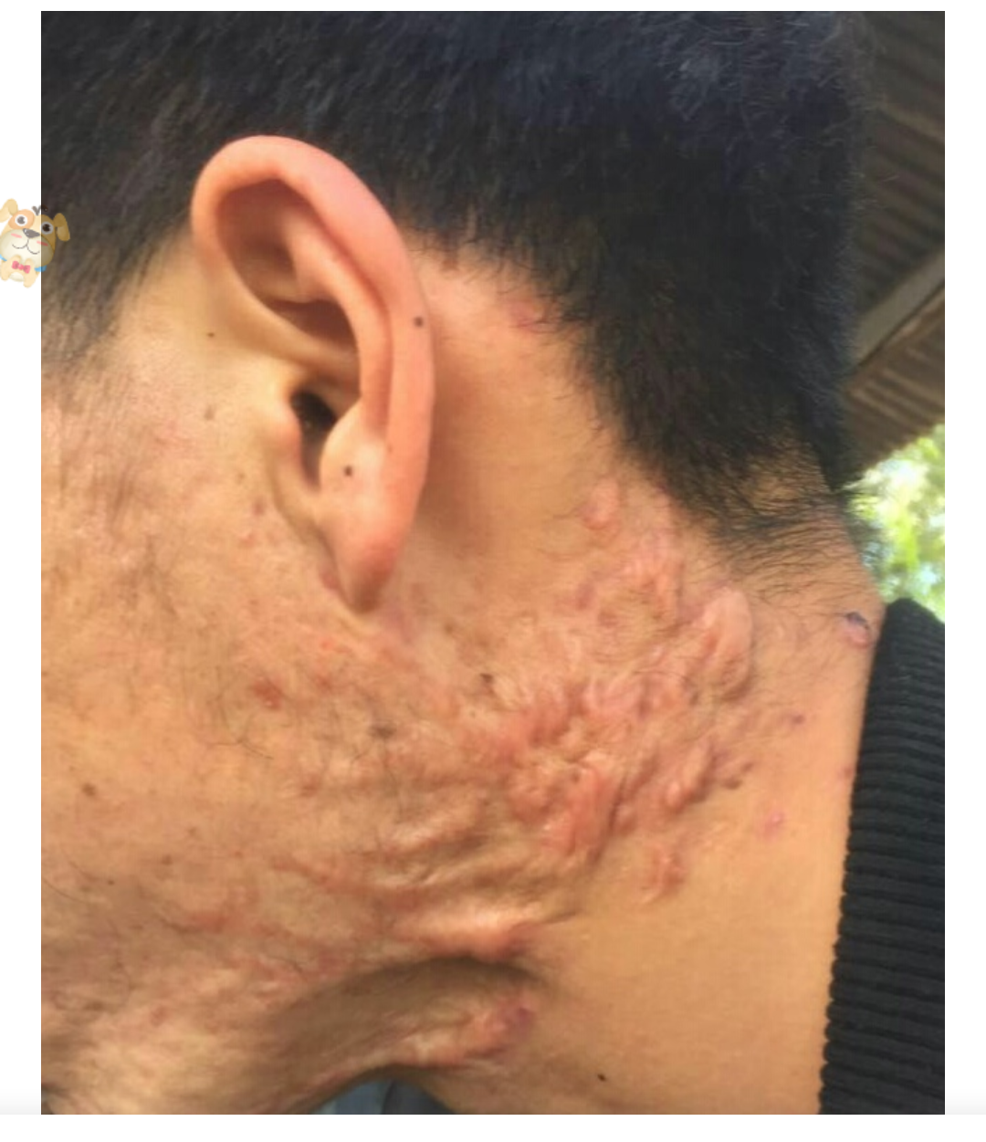 瘢痕疙瘩最好到医院选择同位素敷贴治疗(山东青岛)