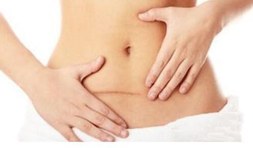 腹壁子宫内膜异位症的新疗法-海扶刀