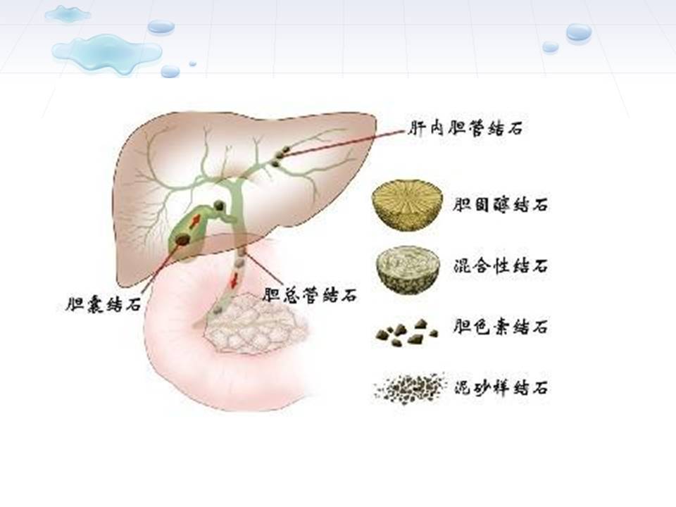 肝内胆管结石的治疗及护理