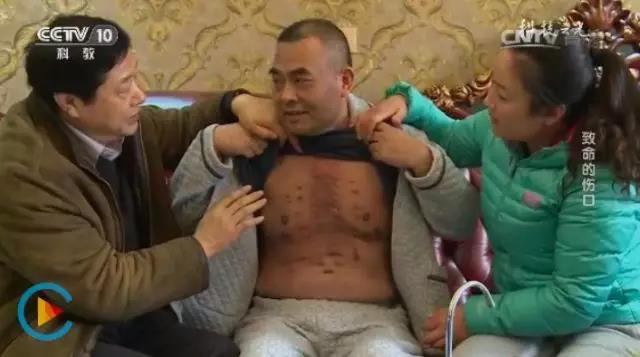 CCTV10《科技之光》:致命的伤口