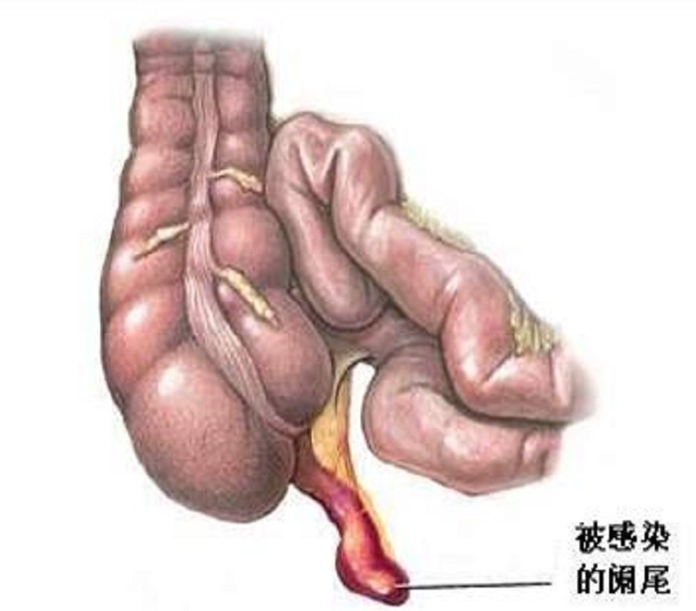 阑尾炎,想说爱你不容易
