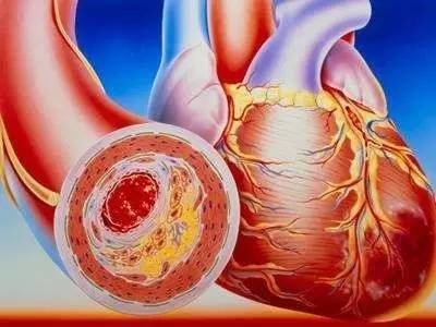 关于血脂高、血粘度高的几个认识