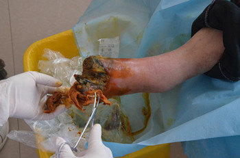 伤口感染溃烂,糖友该怎么处理?