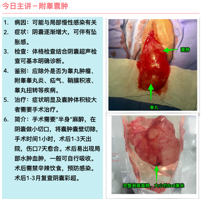 附睾囊肿如何治疗
