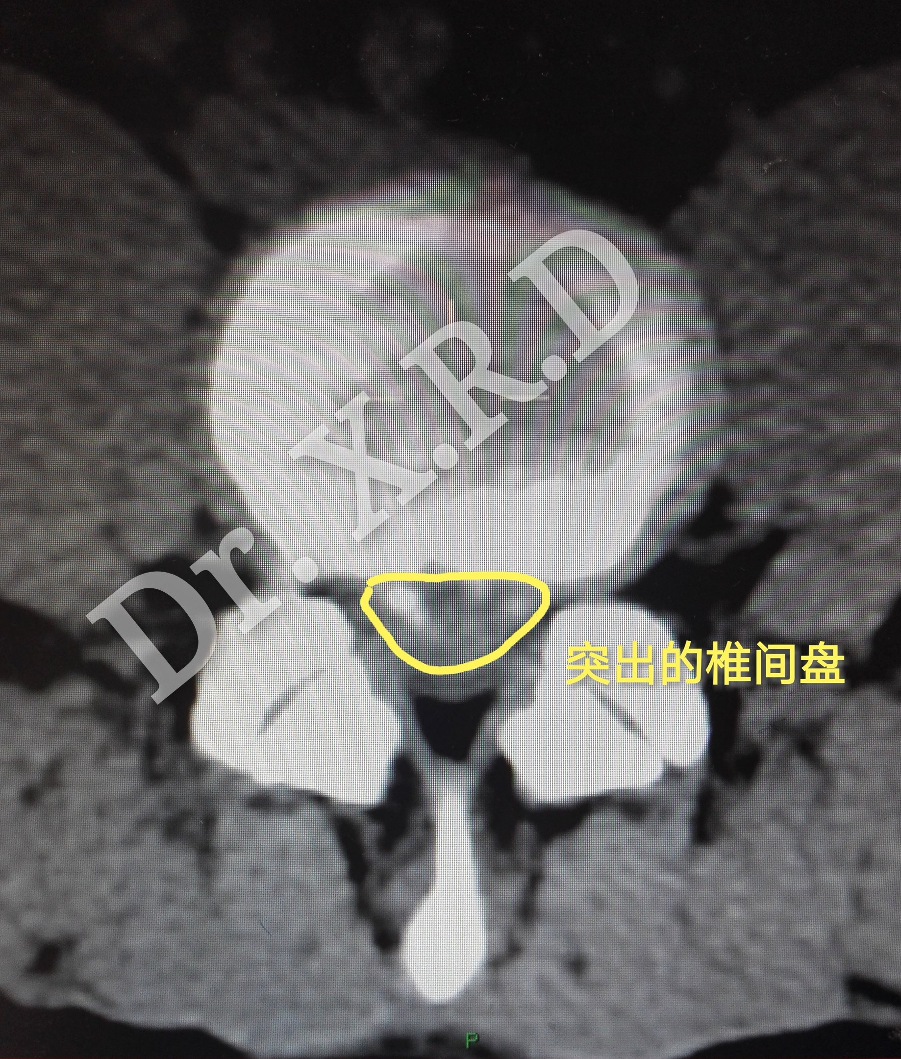 术前ct见巨大的腰椎间盘突出