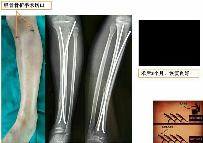 邱俏峰 文章列表  弹性髓内钉技术,被誉为上帝送给骨折孩子的礼物!