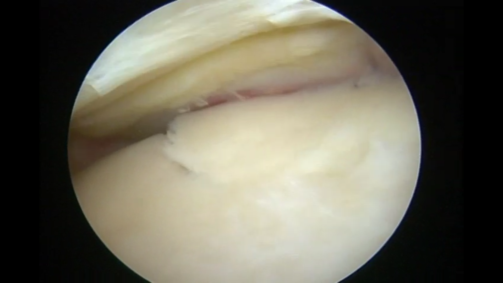 全关节镜下膝关节交叉韧带止点骨折合并胫骨平