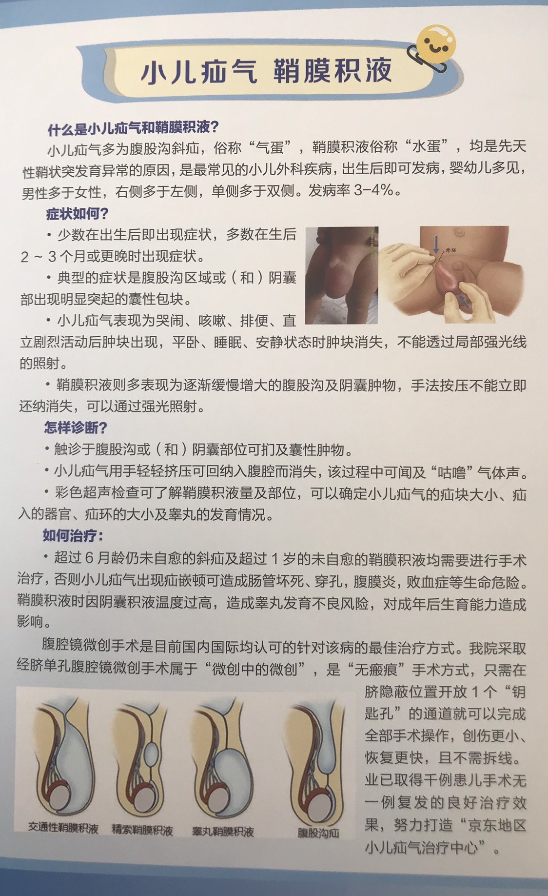 小儿疝气,鞘膜积液