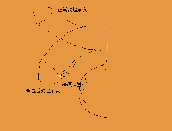 下弯示意图.png