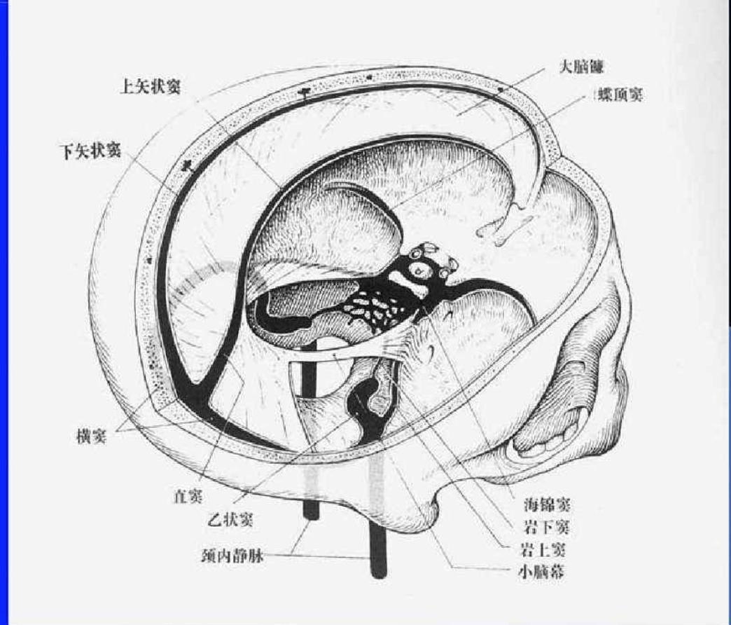 头痛欲裂颅内静脉窦血栓