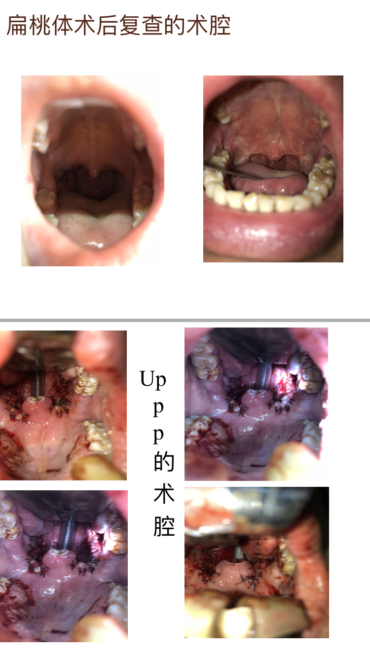 uppp或扁桃体扁桃体切除术后出血原因分析及应对处理策略