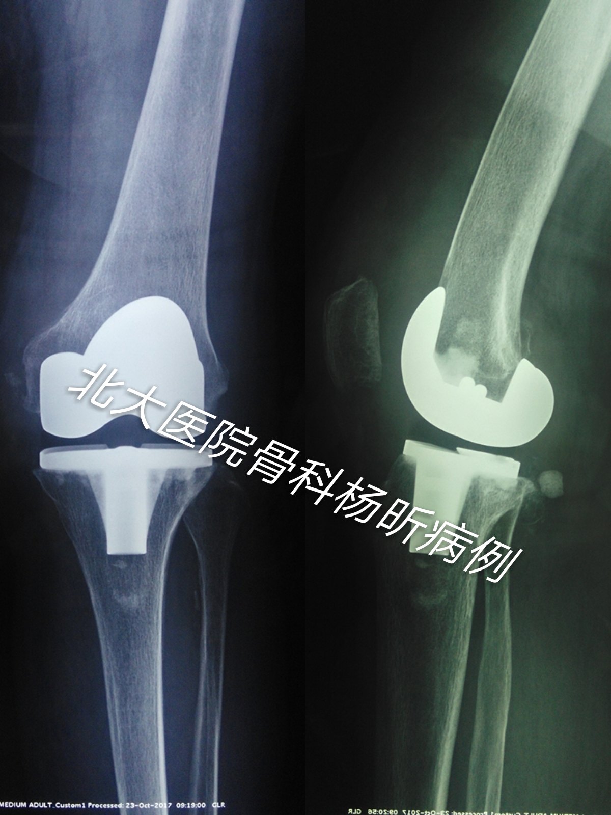一位严重膝关节变形的高龄患者的就诊经历