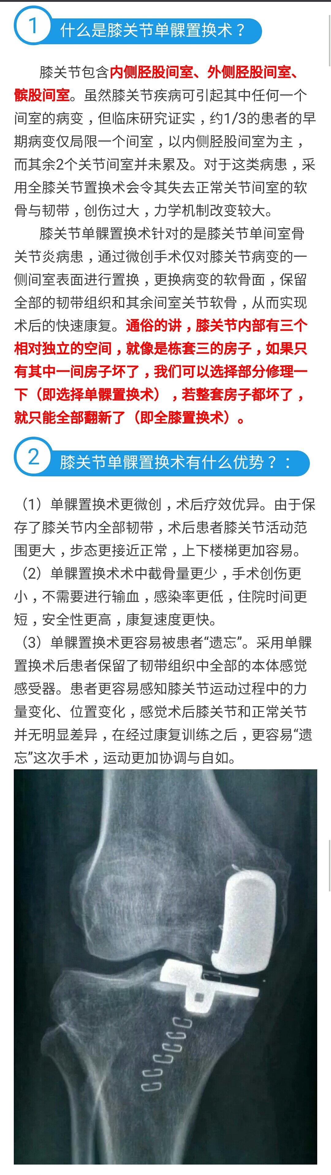 带你了解膝关节单髁置换术