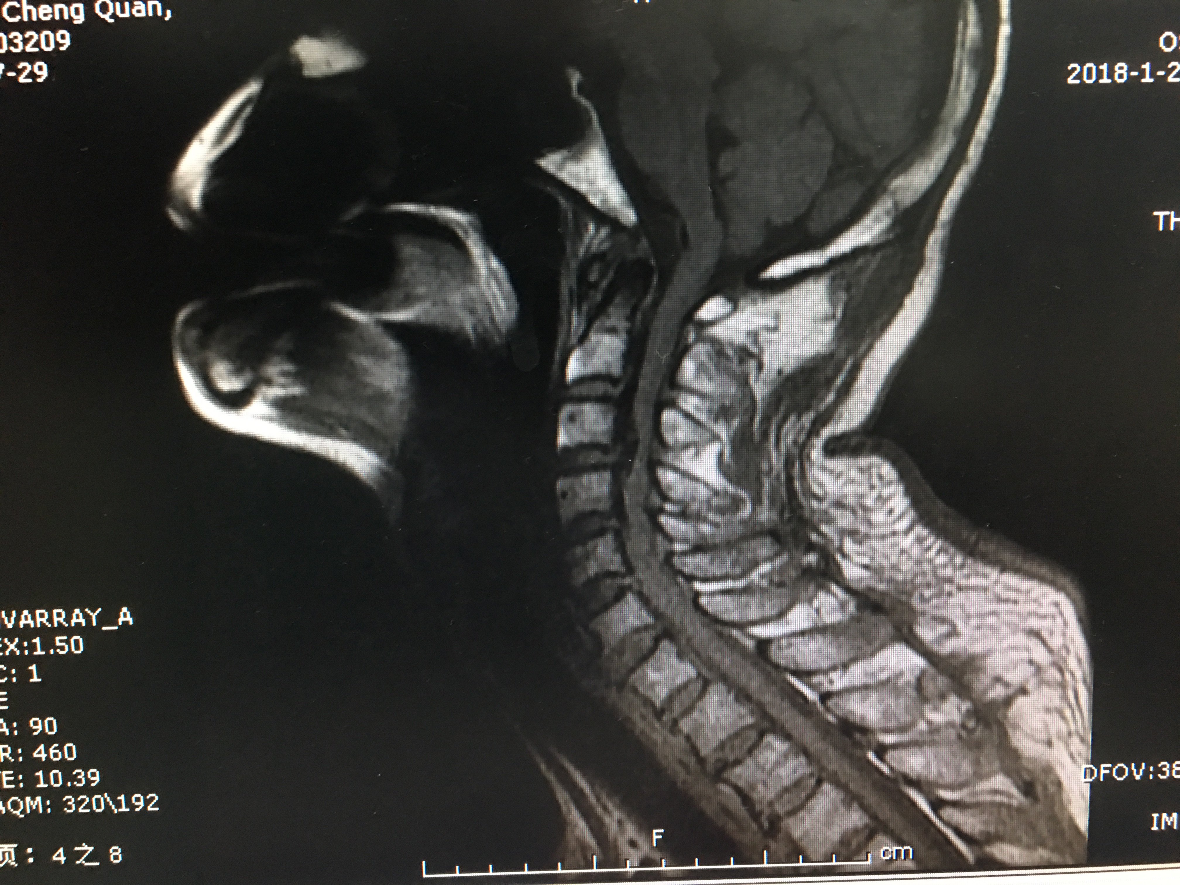 颈椎核磁患者四肢无力 术前无任何不适病例二 这几天下雪路滑,摔倒了