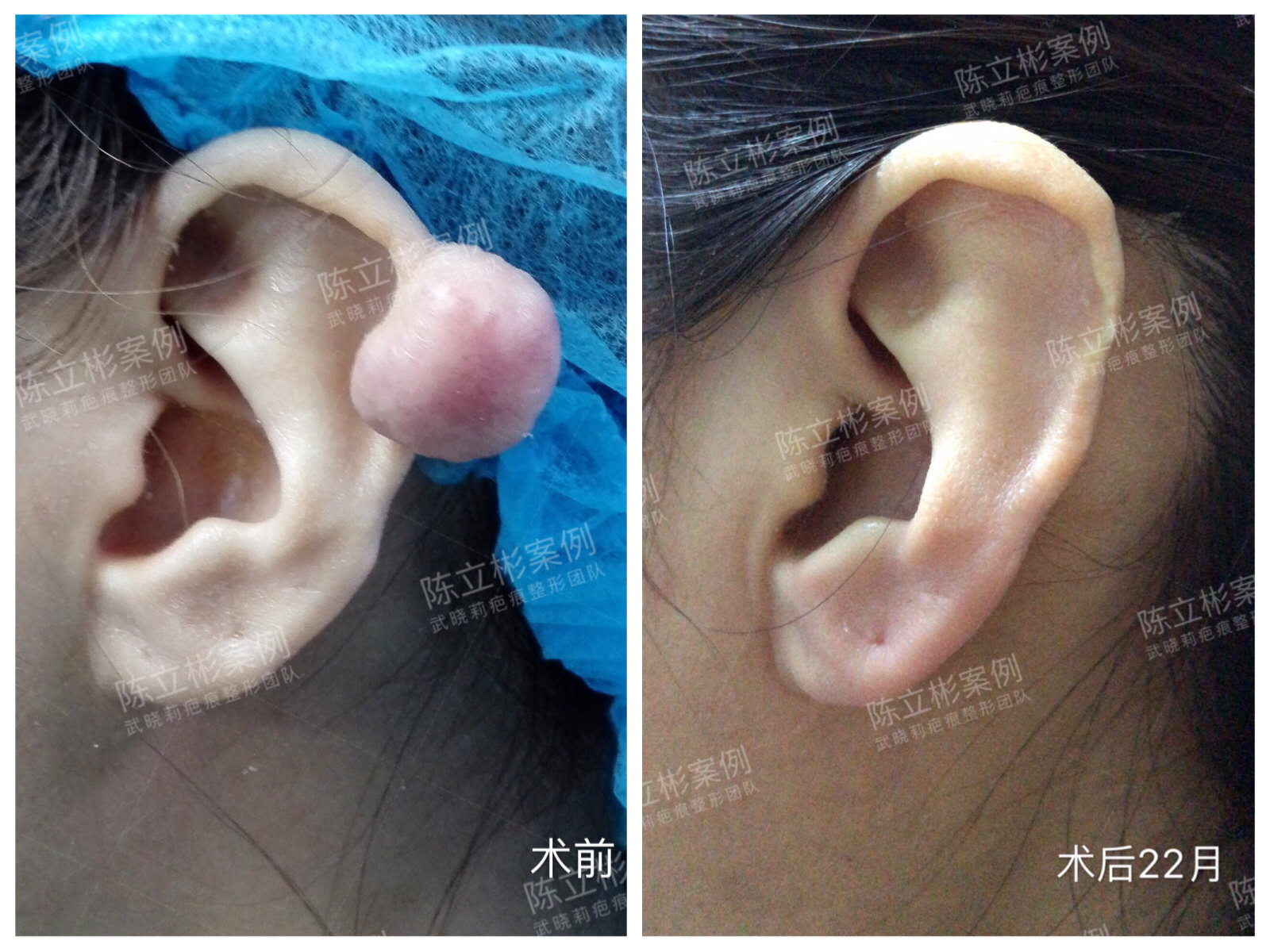 耳廓疤痕疙瘩术后近两年随访