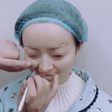 【面部填充】自体脂肪填充法令纹和眉弓骨 --