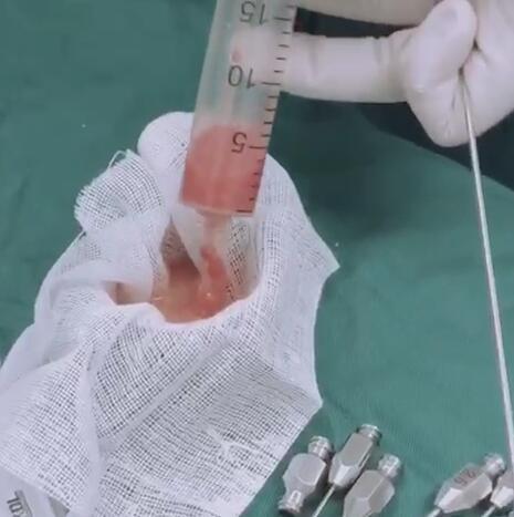 【面部填充】自体脂肪填充法令纹和眉弓骨 -- 