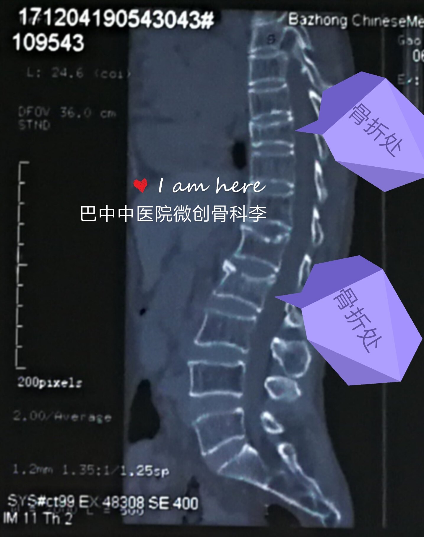 多节段胸腰椎椎体压缩性骨折,行单侧穿刺pkp术,术后患者胸背部疼痛