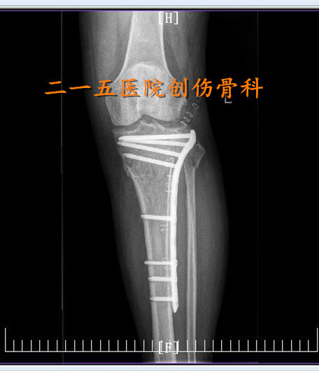胫骨平台骨折术后骨性愈合