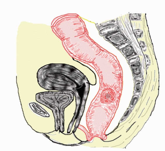 腹腔镜手术图片.gif