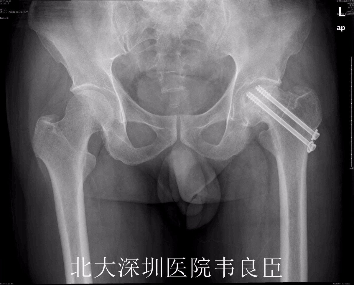 股骨颈骨折,髋臼骨折术后股骨头坏死行髋关节置换病例x片